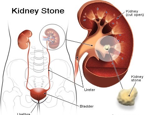 Ayurvedic remedies for kidney diseases