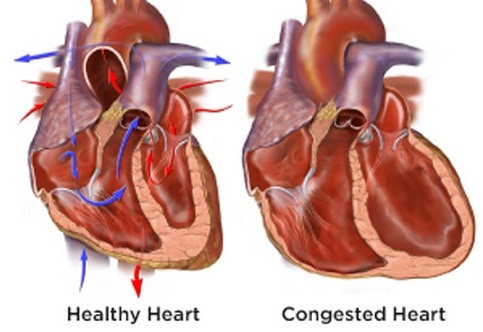 Heart diseases congested heart