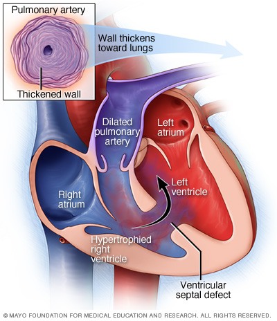 Ventricular Septal Defect VSD