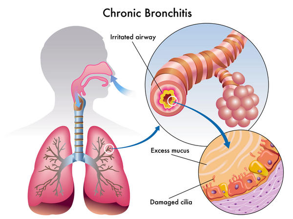 Bronchitis-mechanism