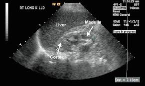 Ultrasound image of chronic Renal Parenchymal disease
