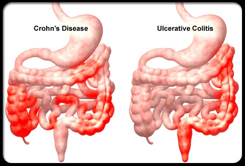 causes of ulcerative colitis