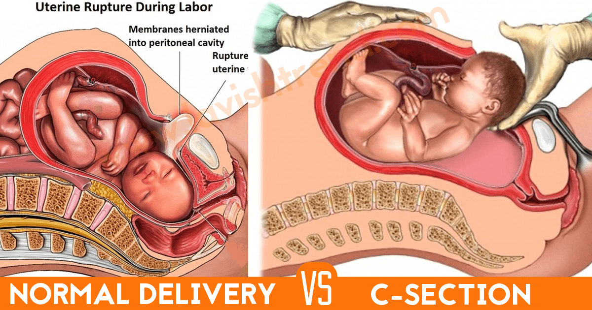 C section over Normal delivery