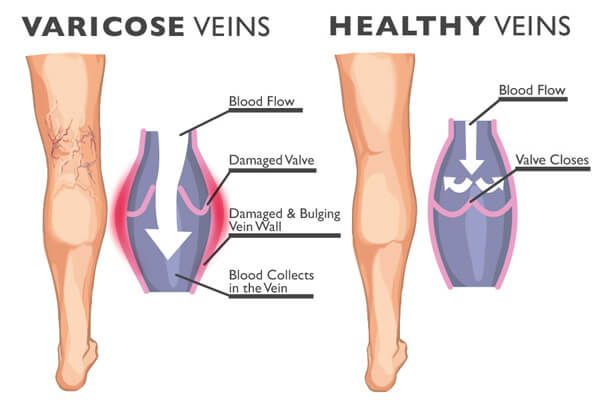 Varicose veins and healthy veins