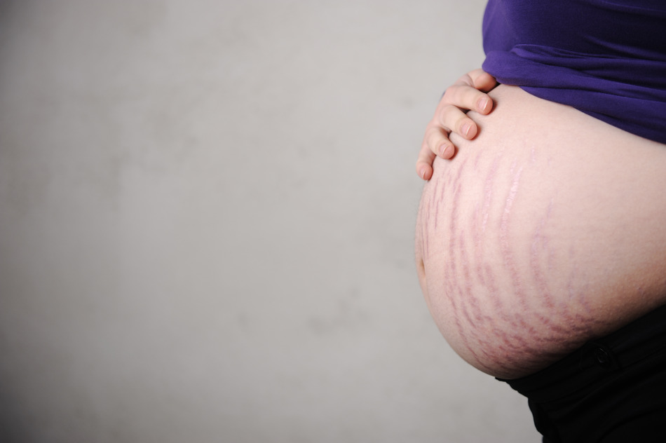 Stretch Marks During Pregnancy