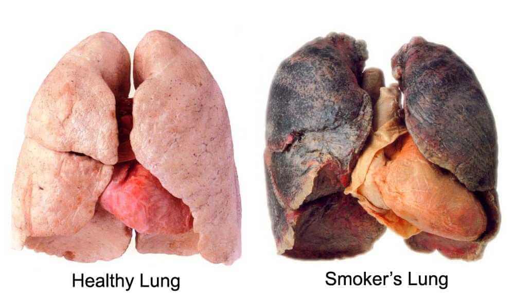 Healthy and Smoking lungs