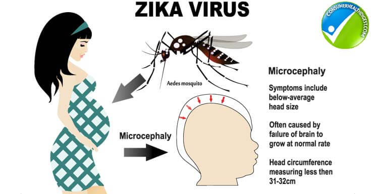 Zika virus and pregnancy