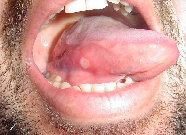 Aphthous ulcer on tongue
