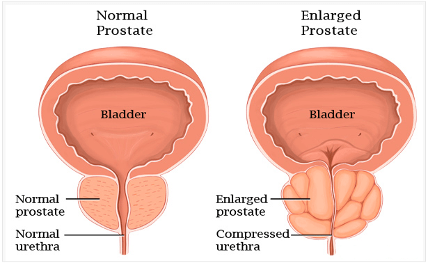 enlarged-prostate-gland