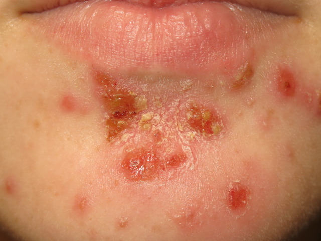 impetigo skin disease