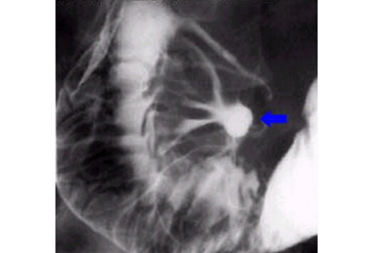 x ray figure of peptic ulcer