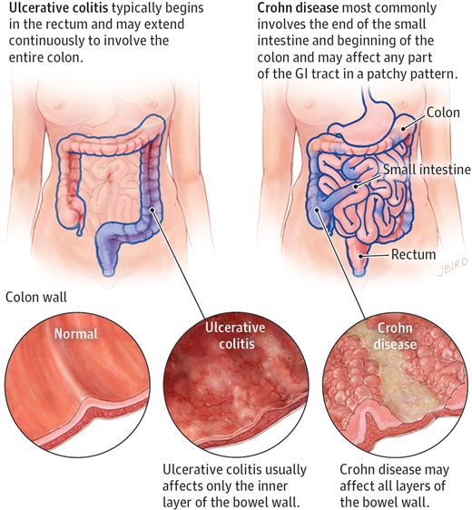Herbal Remedies for Ulcerative colitis