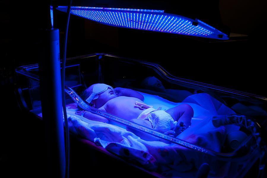 Infant undergoing Phototherapy