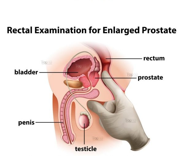 Top 10 Home Remedies for prostate enlargement