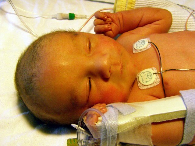 infant with neonatal jaundice