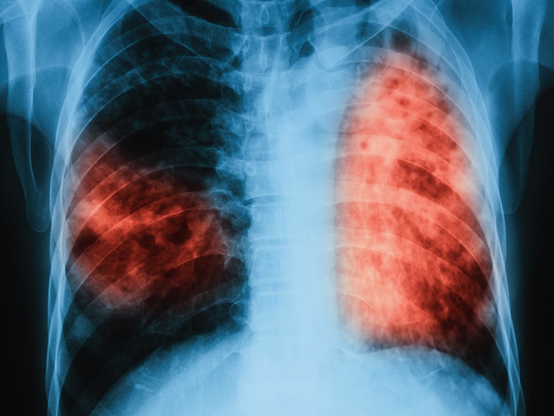 tuberculosis disease