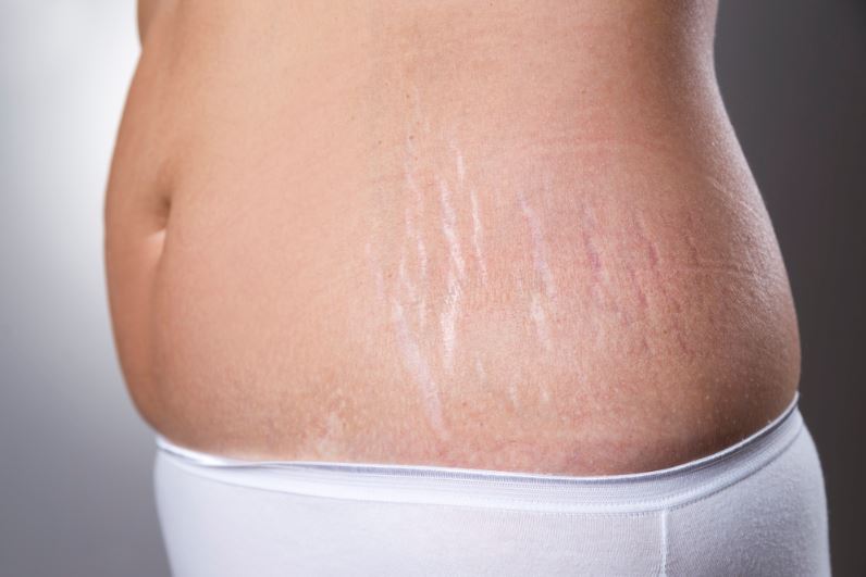 reduce stretch marks after weight loss