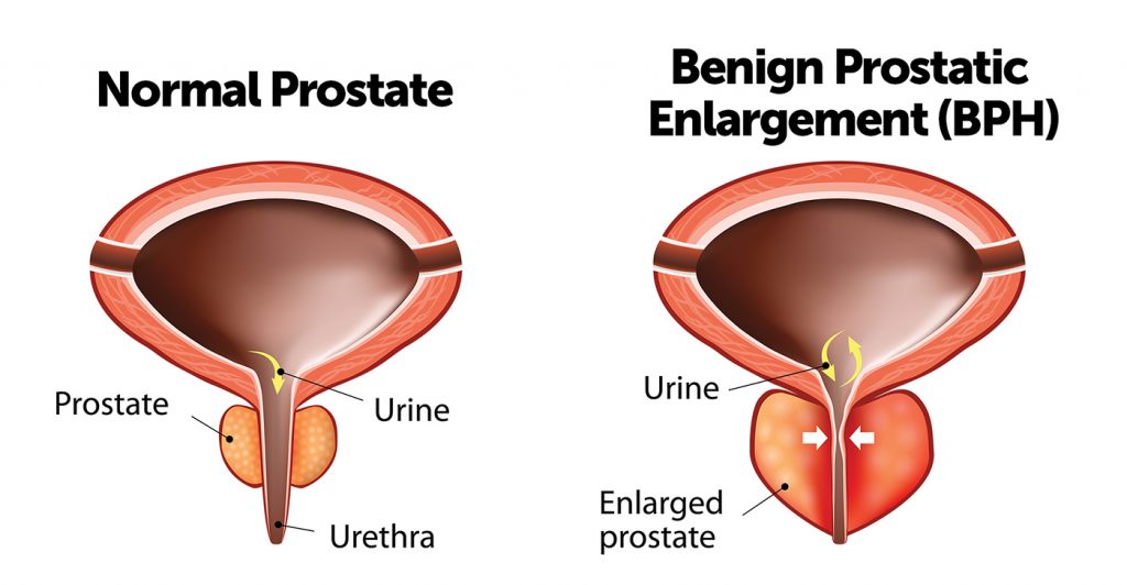 Ayurvedic Treatment for Prostate Enlargement