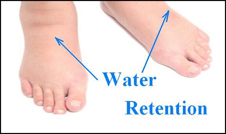 Remedies For Edema (Water Retention)