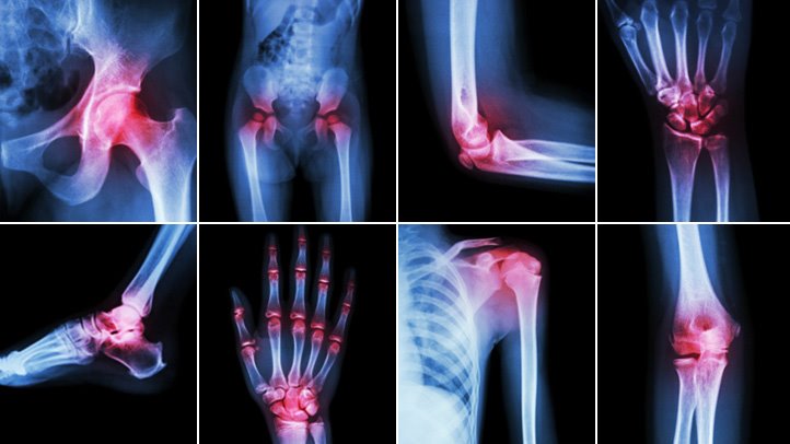 Why Does Arthritis Pain Feel Worse