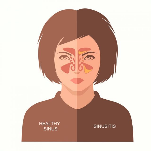Home Remedies for Sinusitis,Remedies for Sinusitis,Sinusitis,Sinusitis Treatment