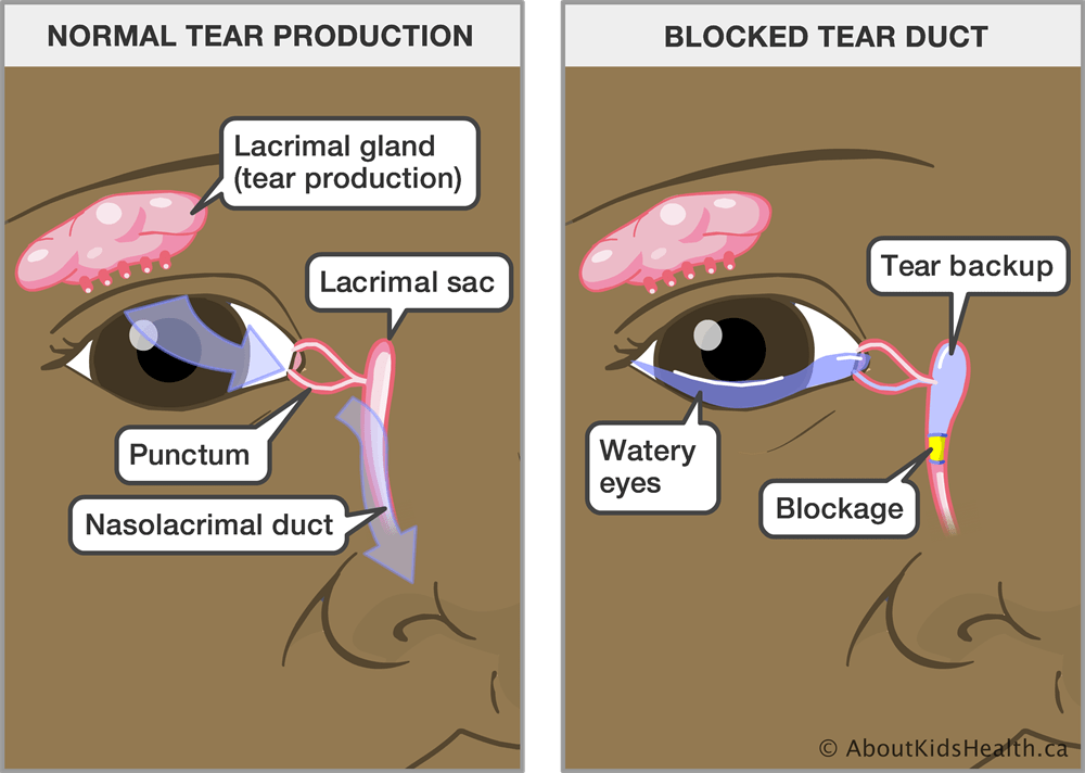 blocked tear duct