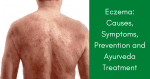 Eczema-treatment-symptoms-ayurveda
