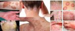 MORE-ABOUT-ECZEMA-ITS-TRIGGERS-TYPES-22