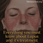 lupus-and-its-treament