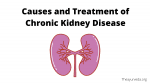 Causes and Treatment of Chronic Kidney Disease