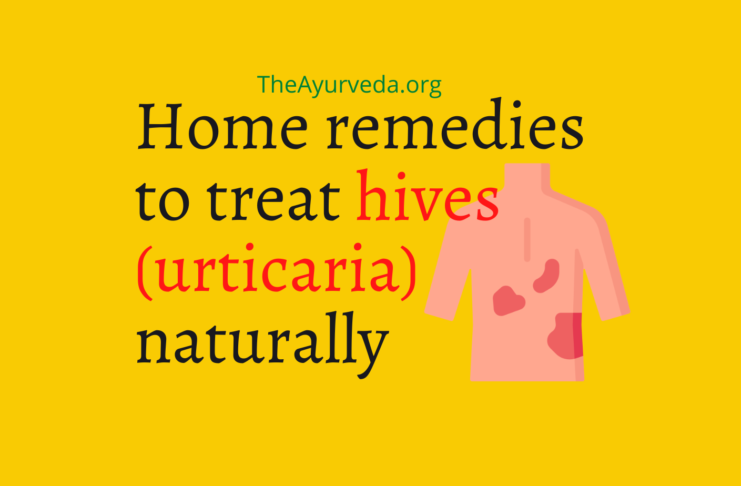 home remedies to treat hives
